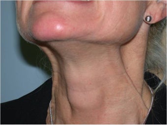 Dysport  treatment of neck Bands