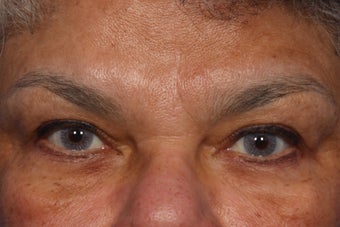 Radiesse and Dysport to Glabella