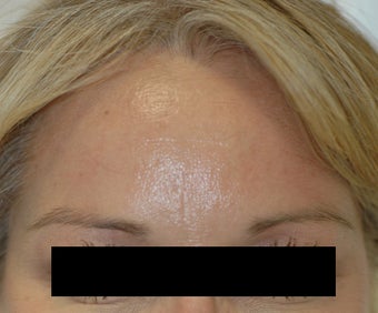 Dysport Injections Orange County Before and After