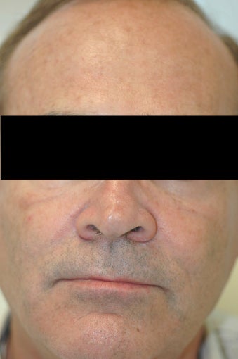 Dysport (Botox) for Forehead Wrinkles, Los Angeles, CA