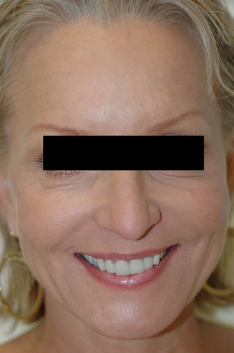 Dysport Injections Before and After Photos