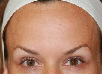 Dysport in the horizontal forehead lines.