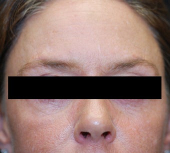 Dysport in the horizontal forehead lines.