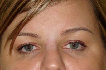 Dysport Injections