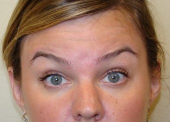 Dysport Injections