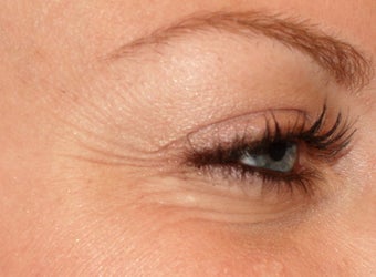 Dysport injections for Crow's Feet