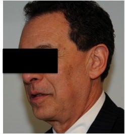 Dysport treatment for Crow's Feet