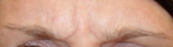 Dysport injections 