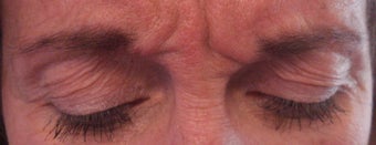 Frown lines treatment