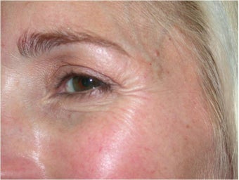 Improvement of crow's feet wrinkles with Dysport