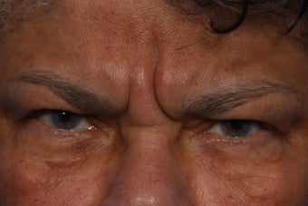 Radiesse and Dysport to Glabella