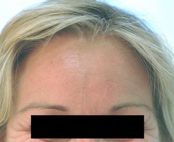 Dysport Injections Orange County Before and After