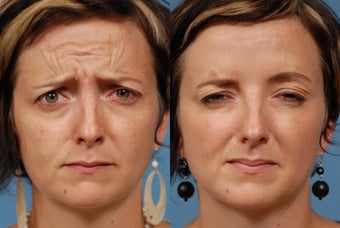 Dysport Treatment