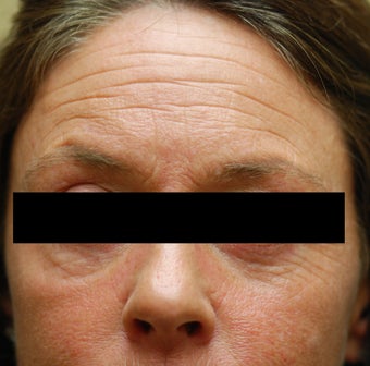 Dysport in the horizontal forehead lines.