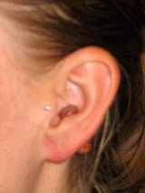 Earlobe Repair