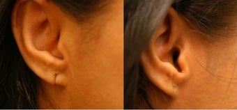 Torn Earlobe Repair