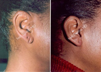 Earlobe Surgery