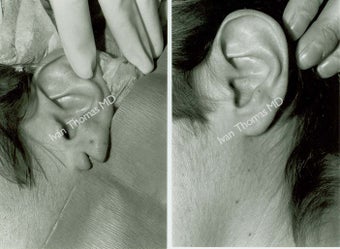 Earlobe Surgery