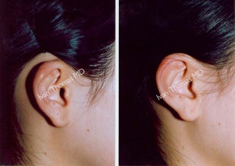 Earlobe Surgery