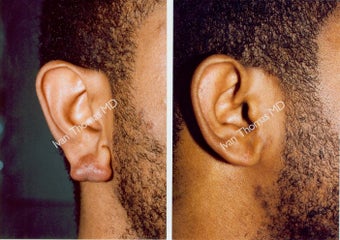 Earlobe Surgery