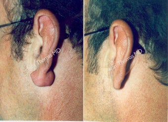 Earlobe Surgery