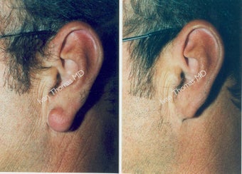 Earlobe Surgery