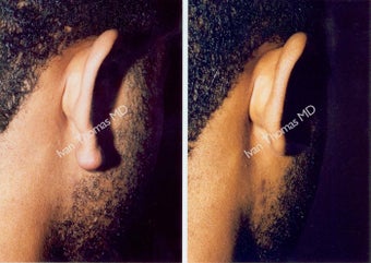 Earlobe Surgery