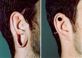 Earlobe Surgery