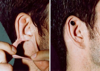 Earlobe Surgery