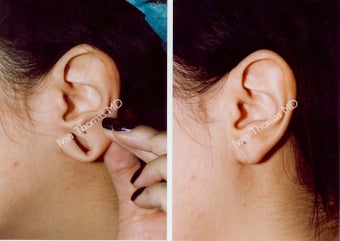 Earlobe Surgery