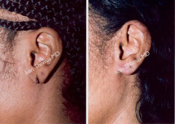 Earlobe Surgery
