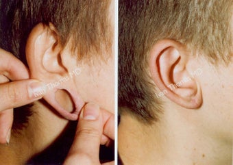 Earlobe Surgery