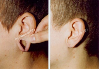 Earlobe Surgery