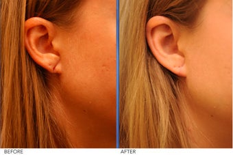 Earlobe Repair