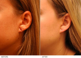 Earlobe Repair- left