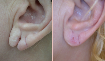Earlobe Repair