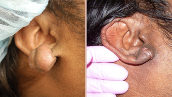 Earlobe Repair