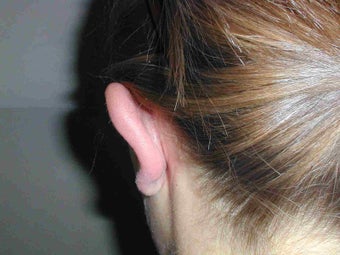One ear Otoplasty