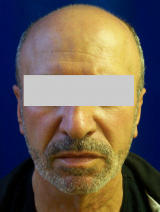 Ear Surgery (otoplasty)