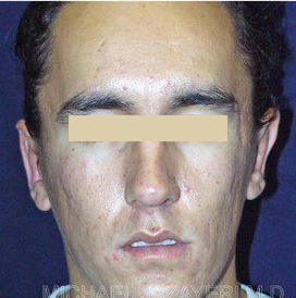 Bilateral Otoplasty (EAR-SET BACK)