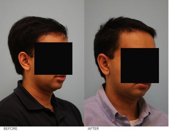 Otoplasty