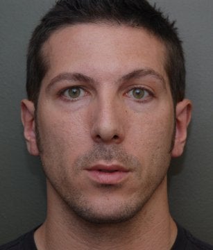 Otoplasty