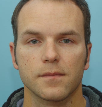 Otoplasty