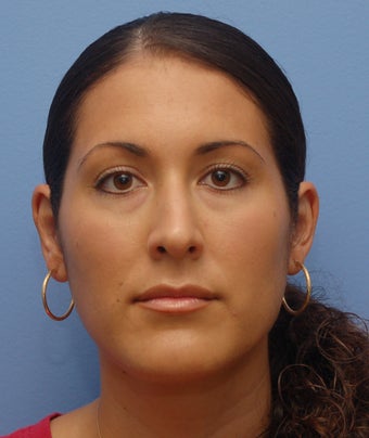 Otoplasty
