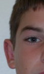 Otoplasty