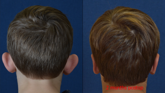 9 Year Old Male Child Treated for Prominent Ears