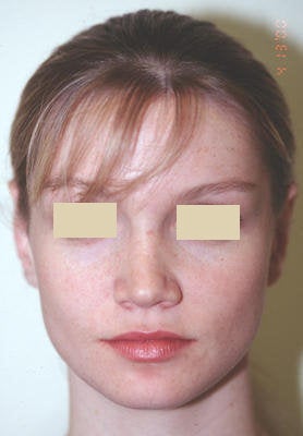 Otoplasty