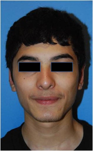 Before and after Otoplasty / Ear Reshaping