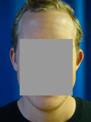 Otoplasty (Ear Surgery)