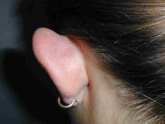 One ear Otoplasty
